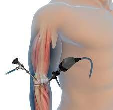 Elbow arthroscopy